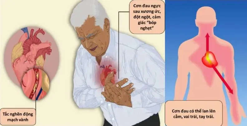 cam-nang-y-khoa-bi-dau-nguc-ben-trai-la-benh-gi-a1