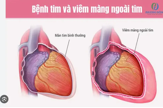 cam-nang-y-khoa-bi-dau-nguc-ben-trai-la-benh-gi-a76